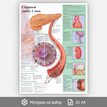 Плакат «Сахарный диабет 2 типа» (ЗОЖ-27, 1 лист)