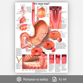 Плакат «Что такое язва?» (ЗОЖ-35, 1 лист)