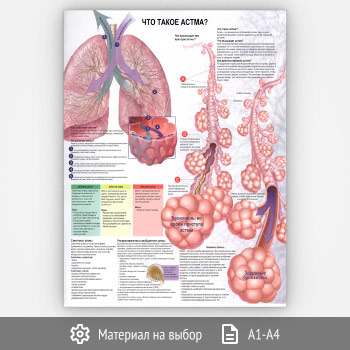 Плакат «Что такое астма?» (ЗОЖ-48, 1 лист)